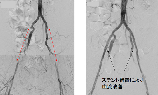 両側外腸骨動脈の慢性完全閉鎖（間歇性跛行）